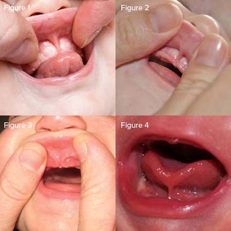 Image montage of 4 infant examples of frenectomy.
