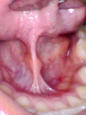 Adult Frenectomy - Lower - After